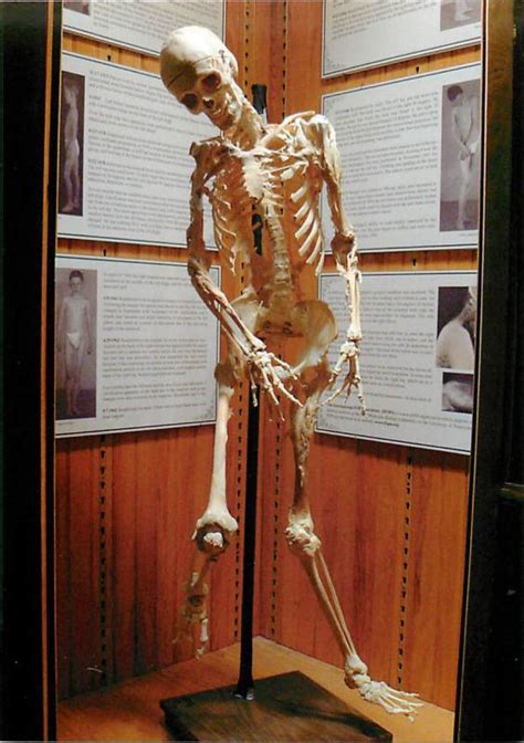 Skeleton of Man with Fibrodysplasia Stone Man Disease at Mutter Museum Postcard | Topics ...