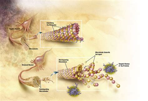 Insulin Resistance and Brain Disease