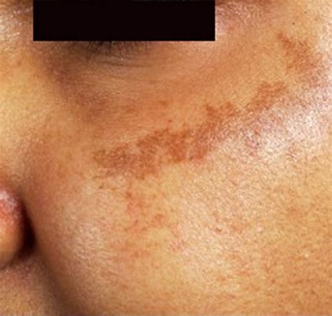 brown spots appearing on skin - pictures, photos