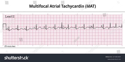 Multifocal Atrial Tachycardia Mat 8 Second Stock Vector (Royalty Free) 2273853047 | Shutterstock