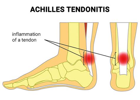 Achilles Tendon Rupture Surgery NJ | Achilles Tendon Tear Repair