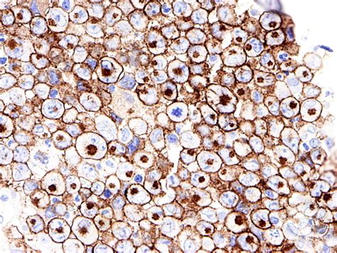 Anaplastic Large Cell Lymphoma Involving the Bone Marrow - 8.