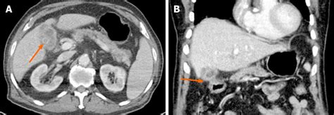 Cholecystoduodenal fistula presenting with upper gastrointestinal bleeding: A case report ...