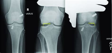 Anteroposterior and varus stress radiographs at 6 months... | Download Scientific Diagram