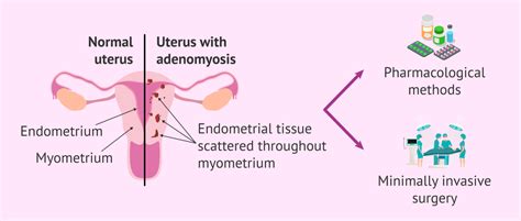 What is Adenomyosis? Risks, Symptoms and Treatment