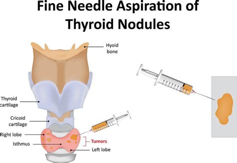 Pin on Thyroid disorders