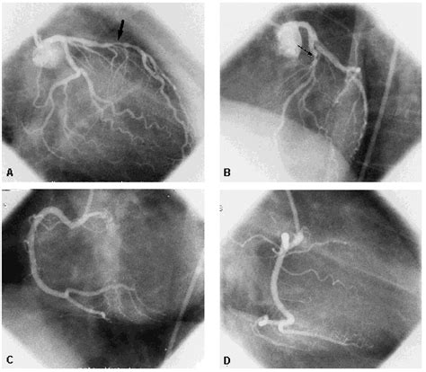 CARDIOLOGIA: CATETERISMO CARDIACO