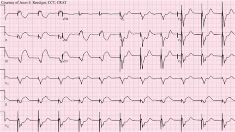 Sgarbossa criteria | ECG Guru - Instructor Resources