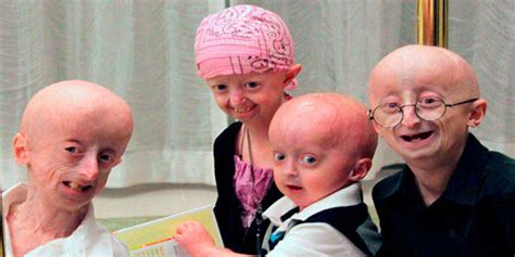 Hutchinson-Gilford progeria syndrome | Newz