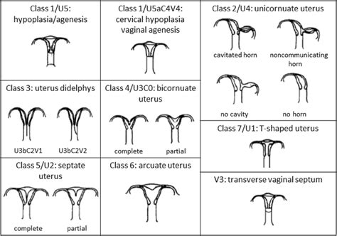 Classification of müllerian duct anomalies according to the AFS and... | Download Scientific Diagram