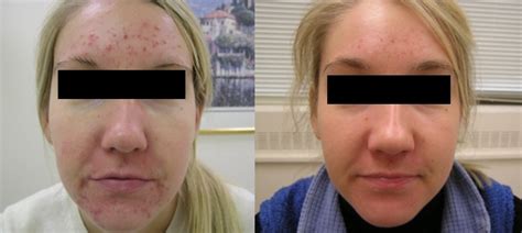 Photodynamic Therapy for Acne | Center for Laser Surgery | Washington, DC