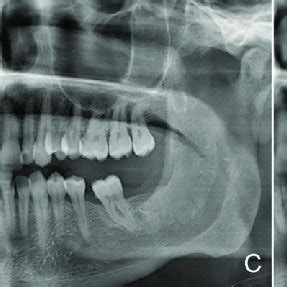 (A) panoramic radiograph of odontogenic keratocyst before... | Download Scientific Diagram