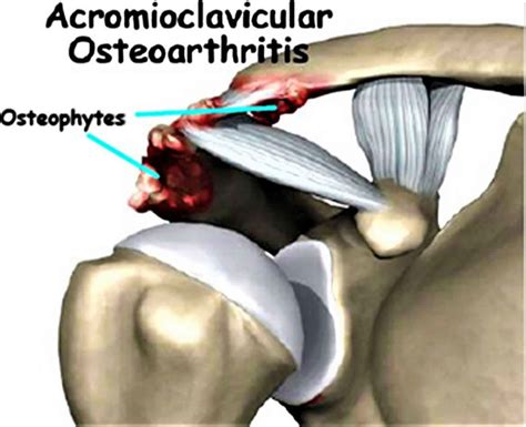 Acromioclavicular joint, acromioclavicular joint injury, separation ...