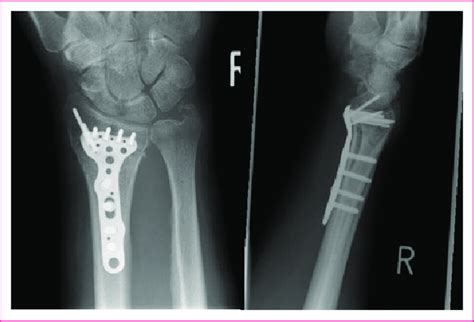 A distal radius fracture stabilised with a locking plate. | Download ...