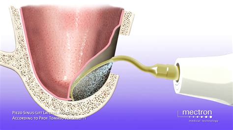 Sinus Lift Lateral Approach