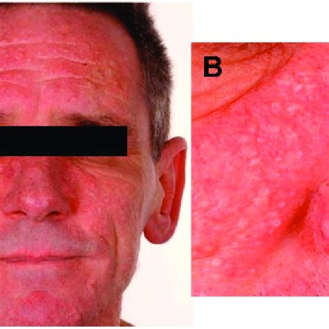 Histolopathology of the superficial fibromatosis tumour showing bland ...