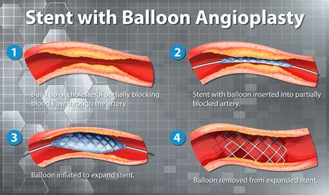 Angioplasty Procedure in Singapore | Apex Heart Clinic