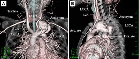 Repair of Tortuous Distal Aortic Arch Aneurysm in a 1-Year-Old Girl With PHACE Syndrome - Annals ...