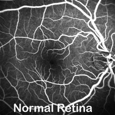 OCT Angiography – Visual Surgery