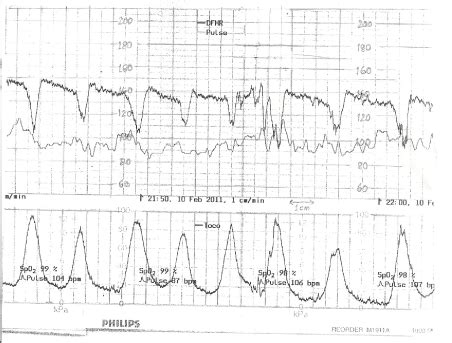 Myths at the core of Intrapartum Cardiotocography Interpretation ...