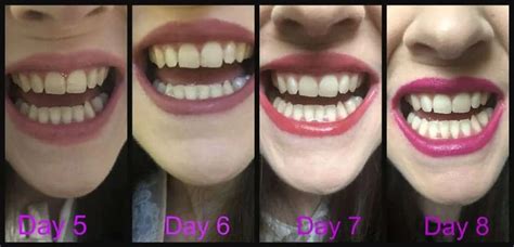 Make a great first impression with Snow teeth whitening kit before and ...