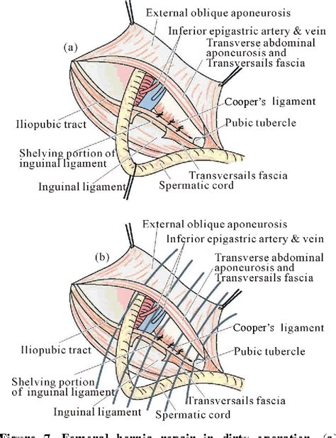 Femoral Hernia Anatomy - Anatomical Charts & Posters