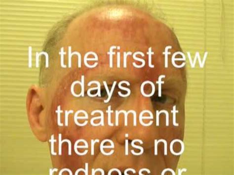 The Effects of Fluorouracil on Actinic Keratoses or Solar Keratoses - YouTube