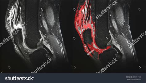 Quadriceps Tendon Tear Knee Mri Stock Photo 343451138 | Shutterstock