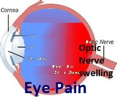 Optic Nerve