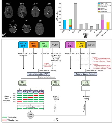 Artificial Intelligence Classifies Brain Tumors With Single MRI Scan