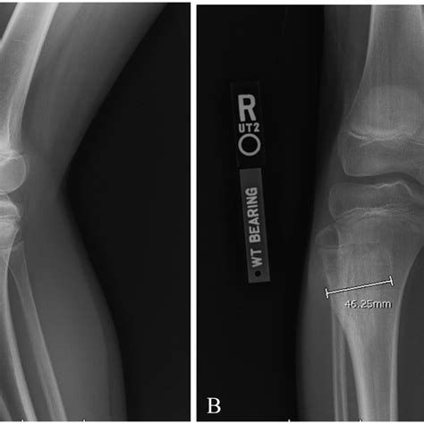 Pre-operative image of large anterior bony prominence just distal to ...