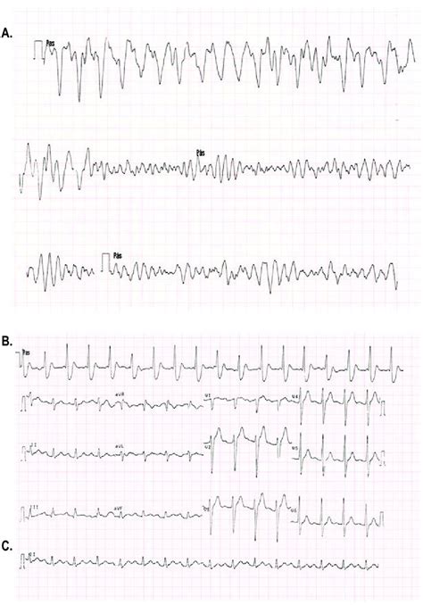 A: Polymorphic ventricular tachycardia degenerating into ventricular... | Download Scientific ...