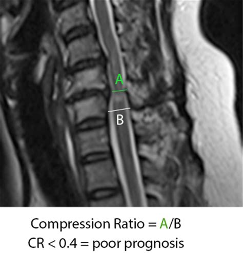 Cervical Myelopathy - Spine - Orthobullets