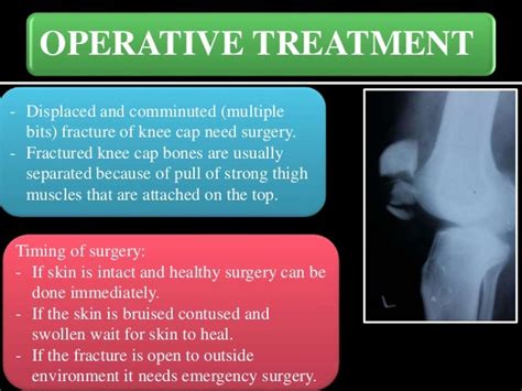 Knee cap (Patella) fractures