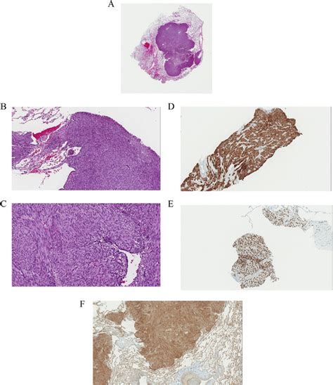 A: Low power view of the lung wedge resection specimen showing a ...