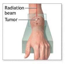 Radiation Therapy for Skin Cancer