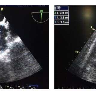 Clinical indications for left atrial appendage closure. | Download Scientific Diagram