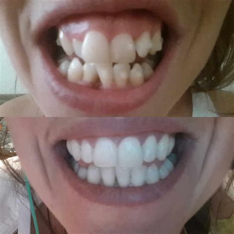 Invisalign Update: 2 Years Of Wearing Braces | Irish Travel Bloggers | Next Stop Who Knows