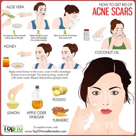 How to Get Rid of Acne Scars | Top 10 Home Remedies