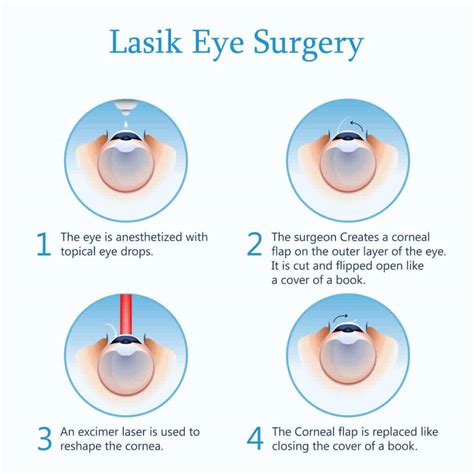 Difference Between LASIK and PRK Surgery? - Dr Geoffrey Ryan