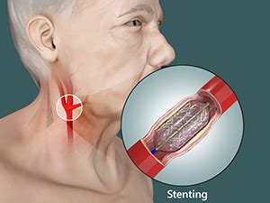 Carotid Stenting Sydney | Carotid Arteries Treatment Sydney