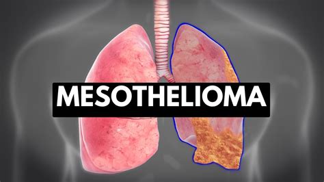 What Causes Mesothelioma - Mesothelioma Nhs - The primary cause of ...