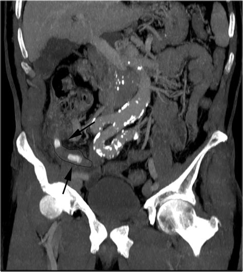 CT scan showing perforated appendix containing two appendicoliths ...