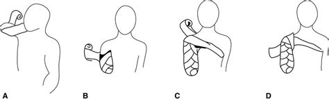 Rehabilitation for Persons with Upper-Extremity Amputation | Musculoskeletal Key