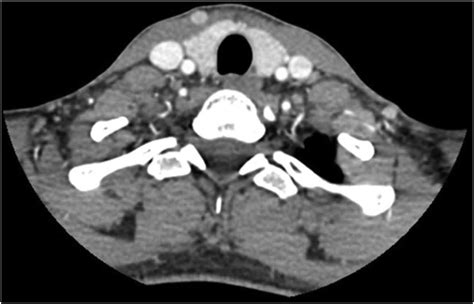 A contrast CT axial scan of the thyroid gland demonstrating no obvious... | Download Scientific ...