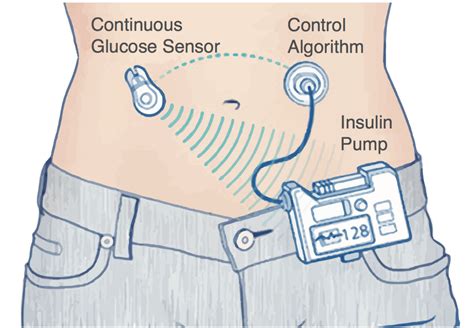 Artificial pancreas shows improved results but longer studies needed to show cost effectiveness ...