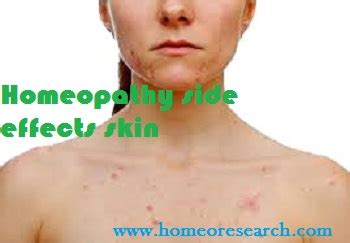 Homeopathy side effects skin Explained - Homeoresearch.com