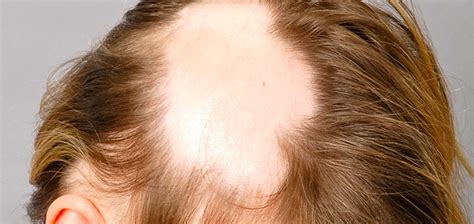 TREATMENT OF ALOPECIA AREATA UNIVERSALIS - Cubaheal