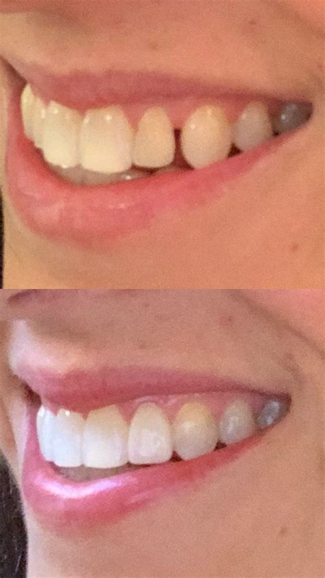 Inspiralized: My Invisalign Experience: Correcting a Crossbite and Crowding