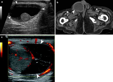 Pampiniform Plexus Ultrasound